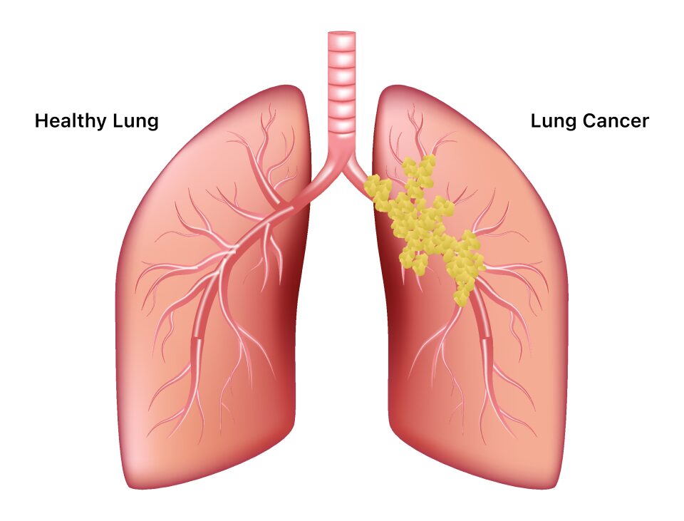 lung cancer patients