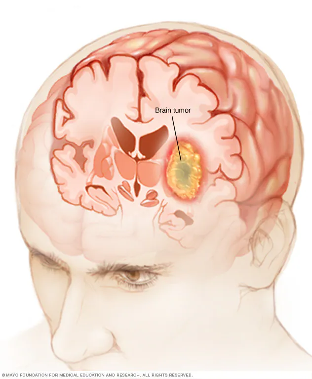  brain tumor